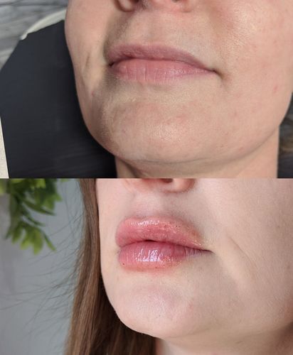Customer photo review of Scalpa HyaInfuse