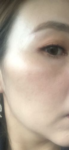 Customer photo review of TriPollar STOP X with extra Preparation Gel