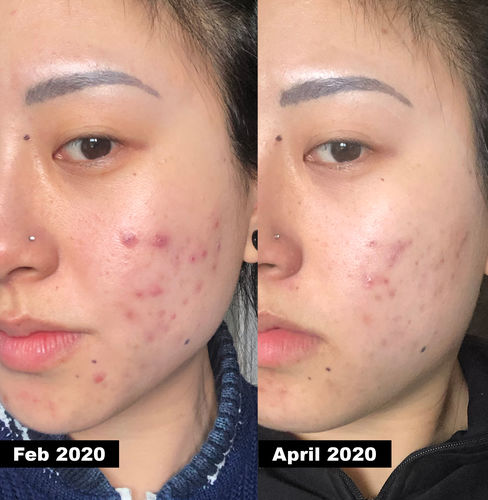cosrx salicylic acid daily gentle cleanser before and after