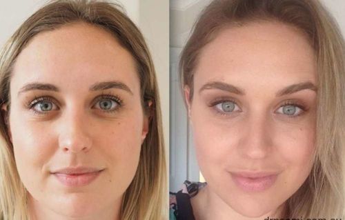 Customer photo review of LessFaceFat™ | De oplossing tegen gezichtsvet