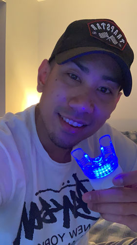 Customer photo review of Teeth Whitening Kit