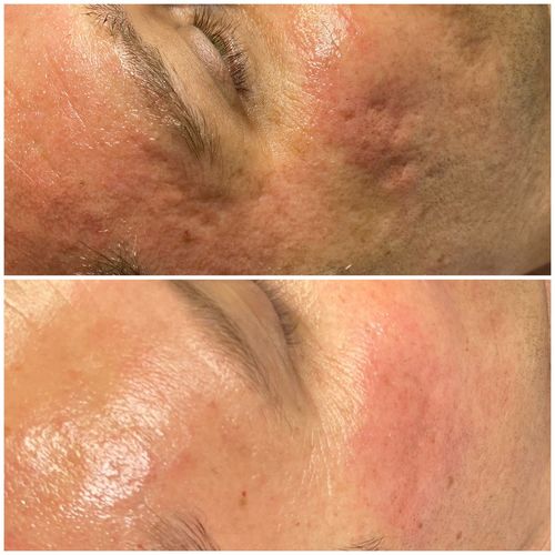 Customer photo review of MesoFirm Serum