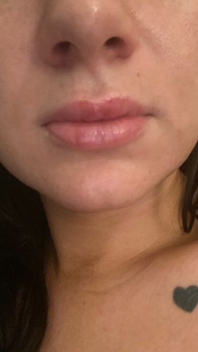 Customer photo review of Hyaluron Pen Ampules