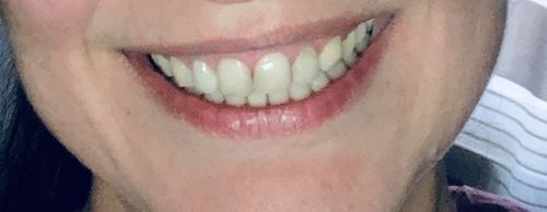 Customer photo review of PAP+ LED Teeth Whitening Kit