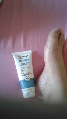 Customer photo review of קרם רגליים טיפולי | DRY SKIN FOOT GEL