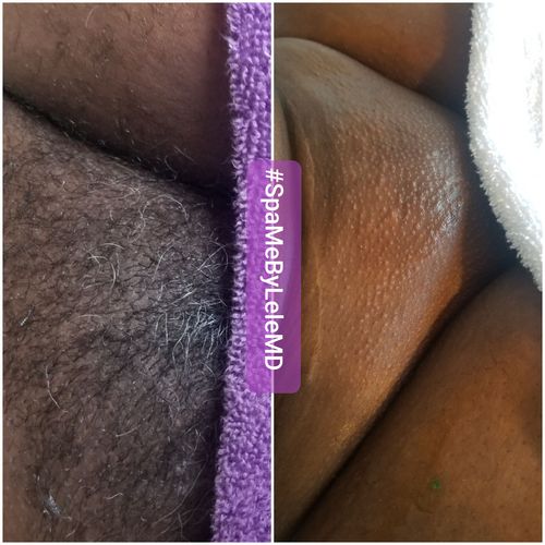 Customer photo review of Pro Series Hair Removal Wax