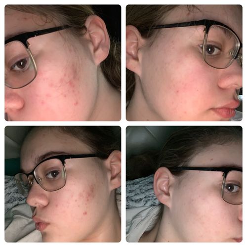 Customer photo review of Niacid