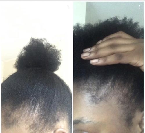 Customer photo review of Inches - Ayurvedic Hair & Beard Growth Oil