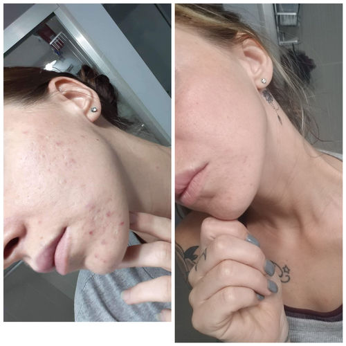 Customer photo review of Niacid