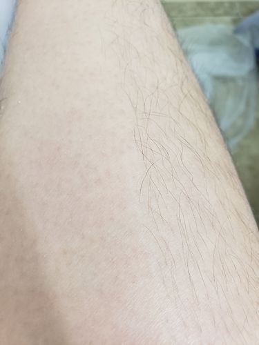 Customer photo review of At-Home Signature Series Hair Removal Wax