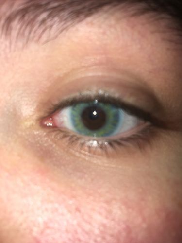 Customer photo review of Cherry Sky Blue Coloured Contact Lenses