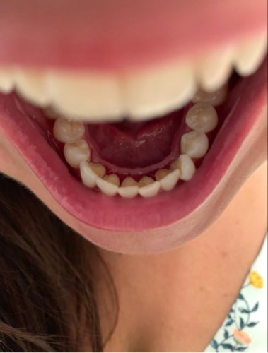 Customer photo review of PORTABLE ELECTRIC DENTAL SCALER