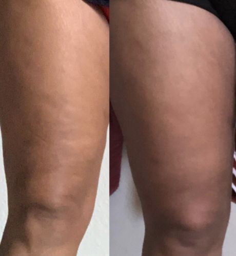 Customer photo review of CavitatUltra™️ - 3 in 1 Fat & Cellulite Remover