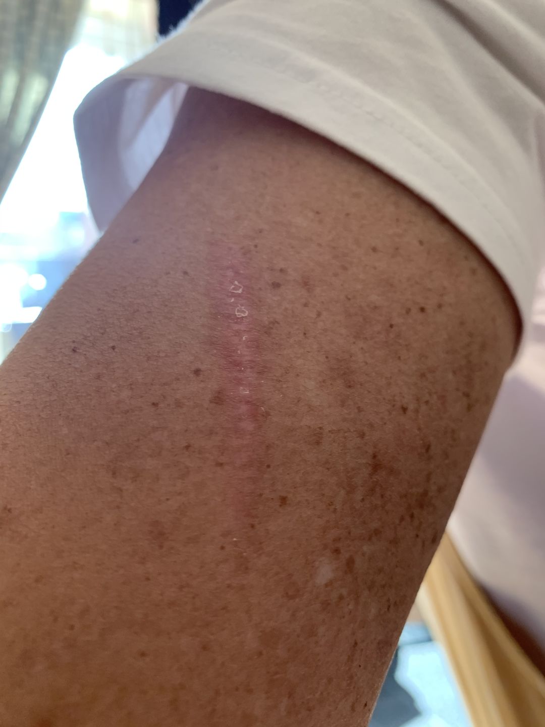 Customer photo review of Scar Minimising Oil