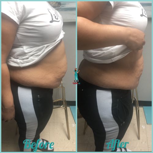 Customer photo review of Dissolve | Lipolysis Fat Reduction Injection