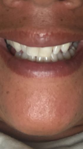 Customer photo review of Teeth Whitening Strips