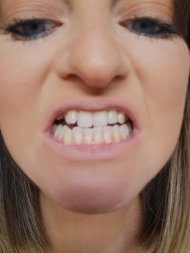 Customer photo review of Teeth Whitening Kit