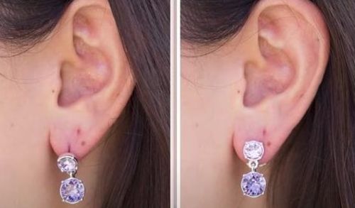 Customer photo review of (2 Pair) Earring Lifters For Stretched Earlobes