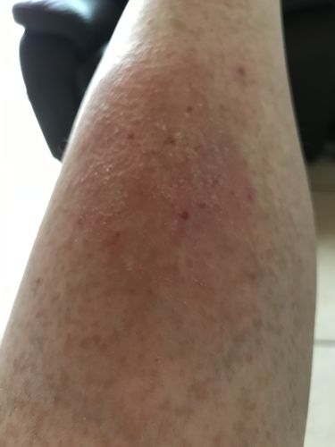 Customer photo review of Soothing Spray