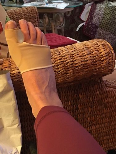 Customer photo review of NovaBunion™ Orthopedic Corrector Sleeve (1 pair)