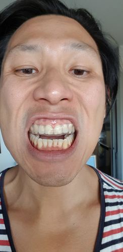 Customer photo review of SleepPro Standard Night Guard 3mm