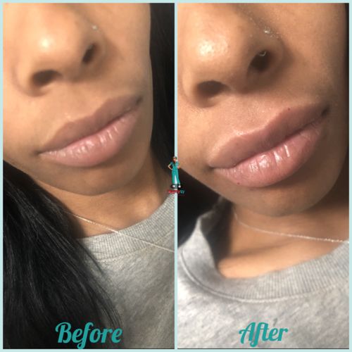 Customer photo review of Hyaluron Pen Ampules