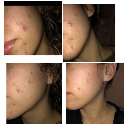 Customer photo review of Niacid