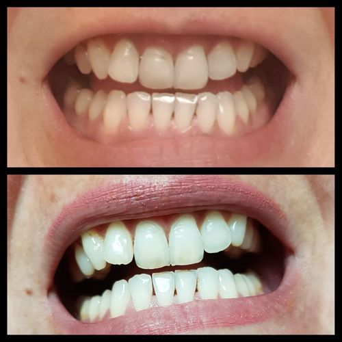 Customer photo review of PAP+ LED Teeth Whitening Kit