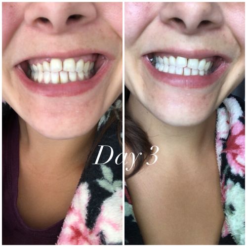 Customer photo review of Teeth Whitening Kit