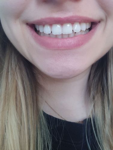 Customer photo review of Teeth Whitening Kit