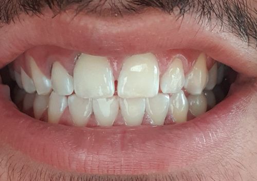 Customer photo review of CocoSmile Aktivkohlepulver