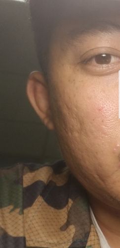 Customer photo review of Niacid