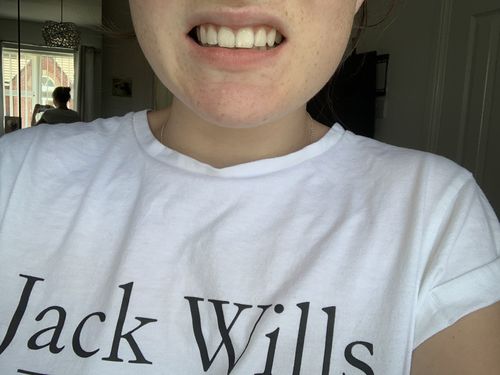 Customer photo review of Teeth Whitening Kit