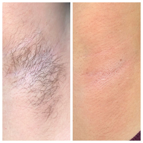 Customer photo review of Signature Series Hair Removal Wax