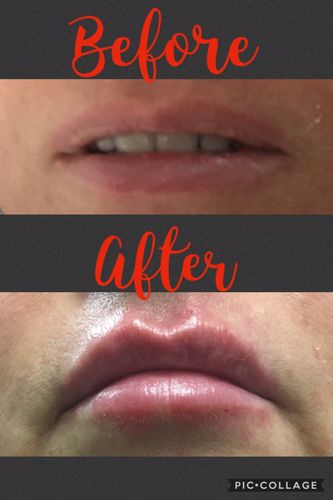 Customer photo review of ScalpaJECT Hyaluronic Acid Gel