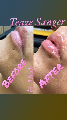 Customer photo review of Hyaluron Pen Ampules