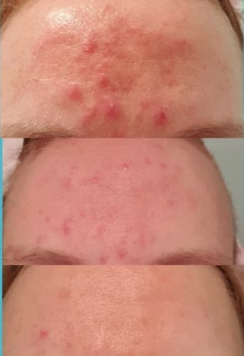 Customer photo review of Photon Therapy Mask