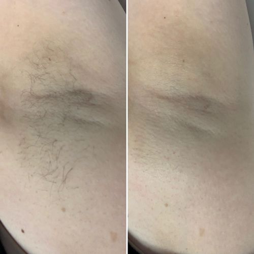 Customer photo review of Pro Series Hair Removal Wax