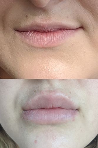 Customer photo review of ScalpaJECT Hyaluronic Acid Gel