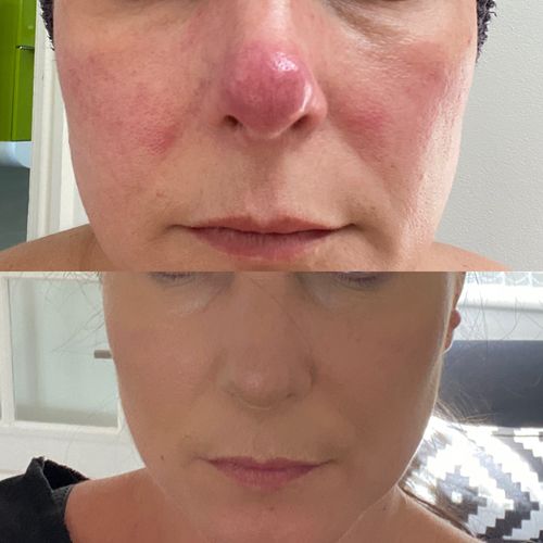Customer photo review of Rosalique 3 in 1 Anti-Redness Miracle Formula SPF50