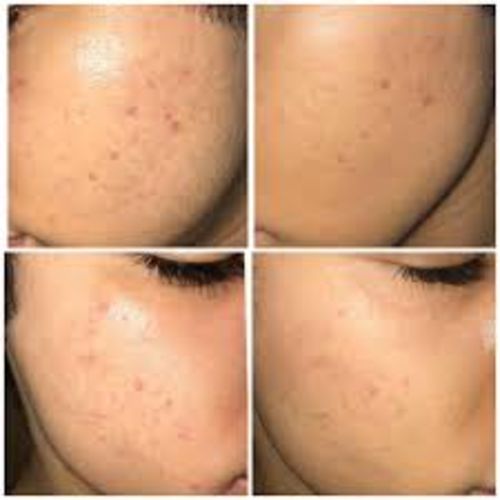 Customer photo review of Niacid