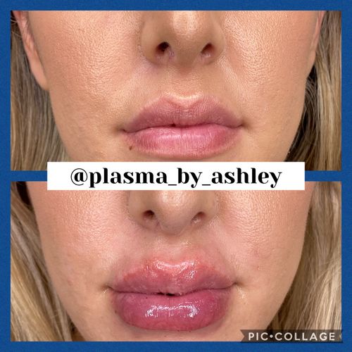 Customer photo review of ScalpaJECT Hyaluronic Acid Gel