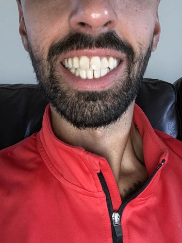 Customer photo review of Teeth Whitening Kit