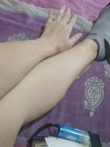 Customer photo review of Waxaro™ Professional Laser Hair Removal For Women