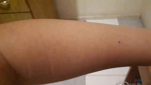 Customer photo review of Best at Home IPL Laser Hair Removal Device