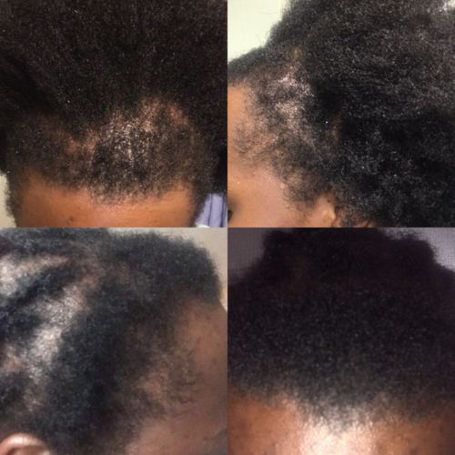 Customer photo review of Inches - Ayurvedic Hair & Beard Growth Oil