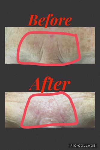 Customer photo review of ScalpaJECT Hyaluronic Acid Gel