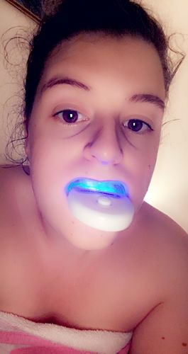 Customer photo review of Teeth Whitening Kit