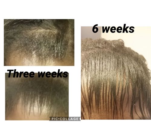 Customer photo review of India’s  Secret Herbal Hair Growth Stimulator (1.69oz) Grow at least 1 inch a month