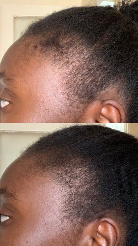 Customer photo review of Inches - Ayurvedic Hair & Beard Growth Oil